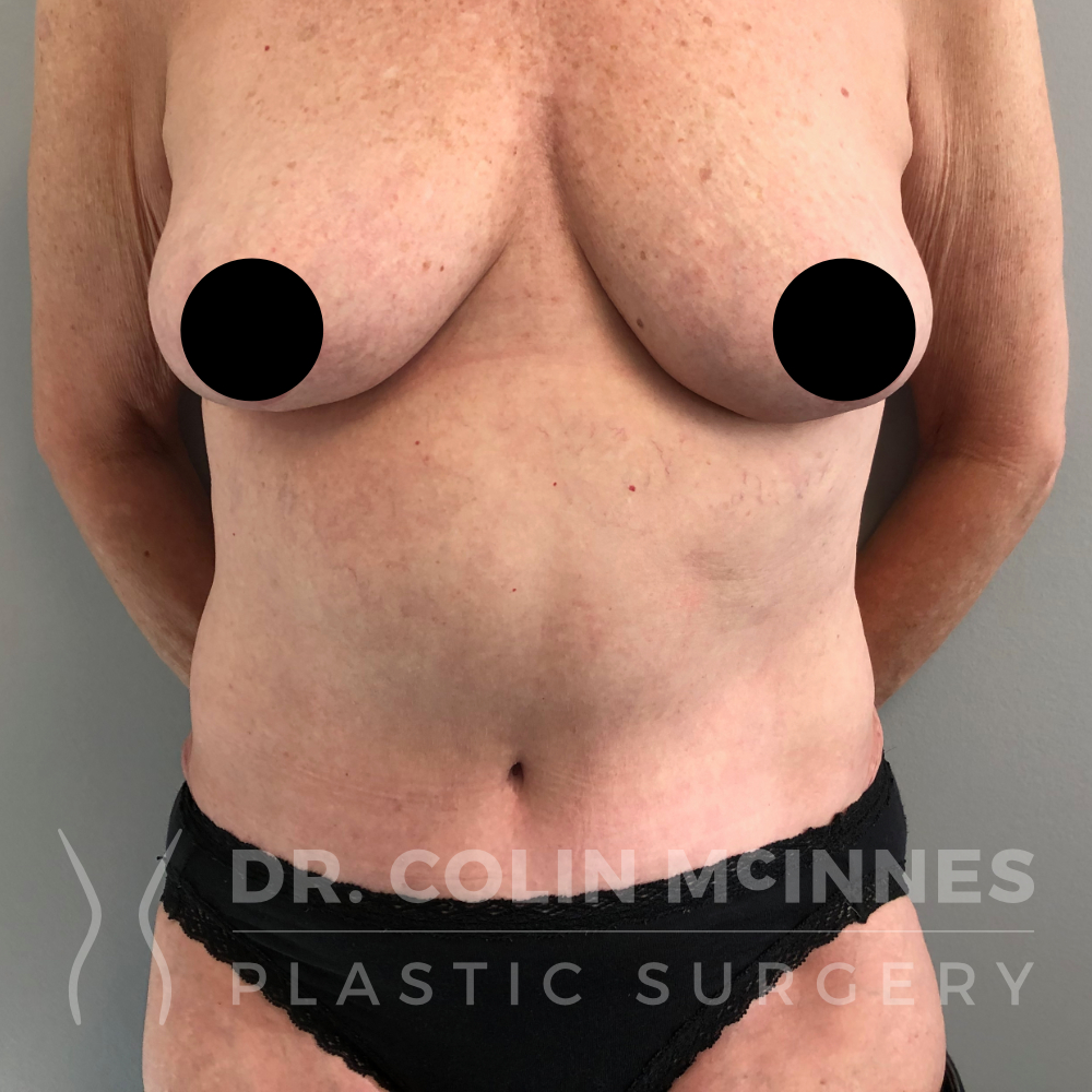 Breast reduction, abdominoplasty & liposuction - 1 YEAR POST OP